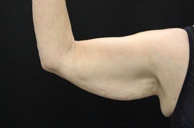 Arm Lift: Case 19 - Before