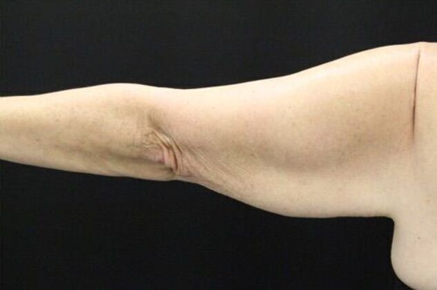 Arm Lift: Case 19 - Before