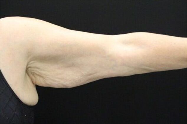 Arm Lift: Case 19 - Before