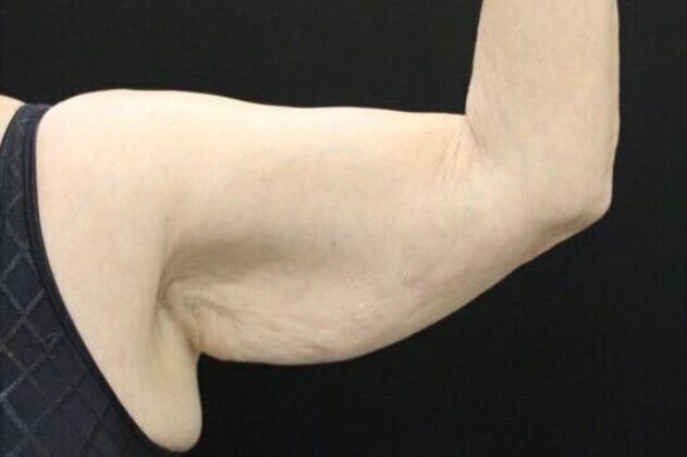 Arm Lift: Case 19 - Before