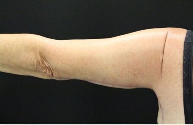 Arm Lift: Case 19 - After