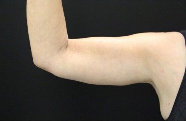 Arm Lift: Case 19 - After