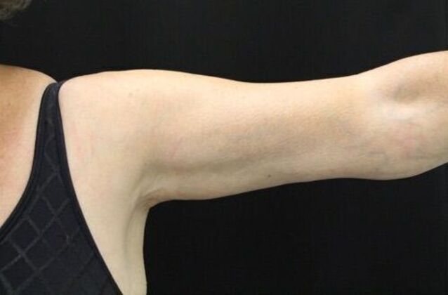 Arm Lift: Case 19 - After