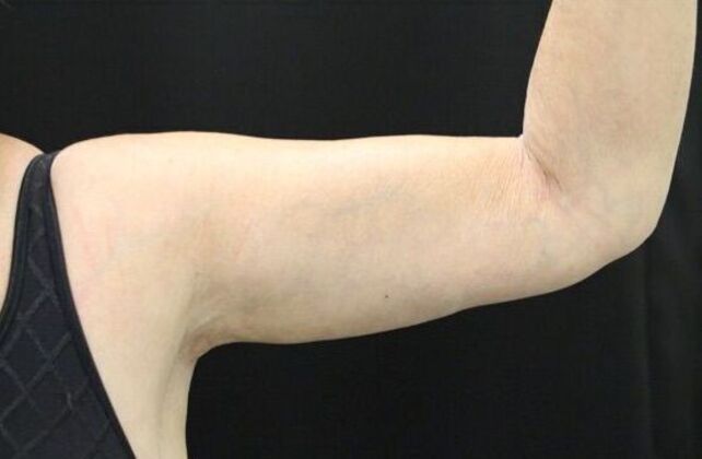 Arm Lift: Case 19 - After