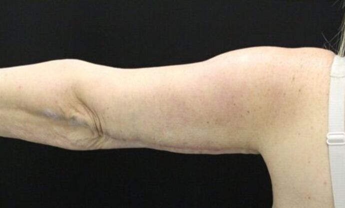 Arm Lift: Case 20 - Before