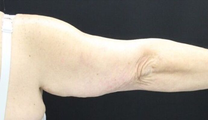 Arm Lift: Case 20 - Before