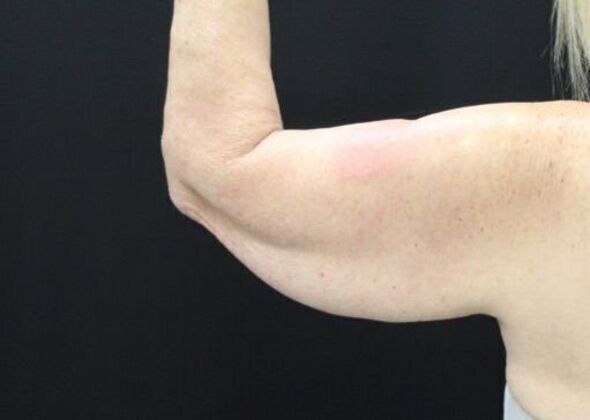 Arm Lift: Case 20 - Before