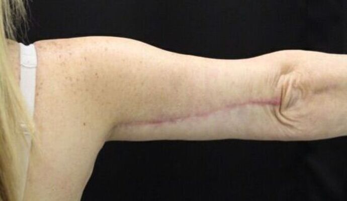 Arm Lift: Case 20 - After