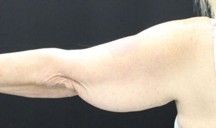 Arm Lift: Case 20 - After