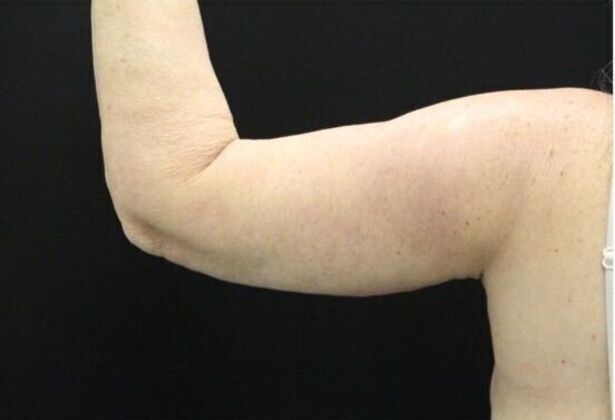 Arm Lift: Case 20 - After
