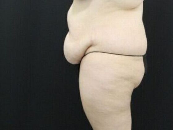 Tummy Tuck: Case 44 - Before