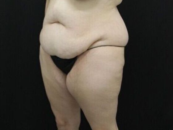 Tummy Tuck: Case 44 - Before