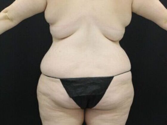 Tummy Tuck: Case 44 - Before