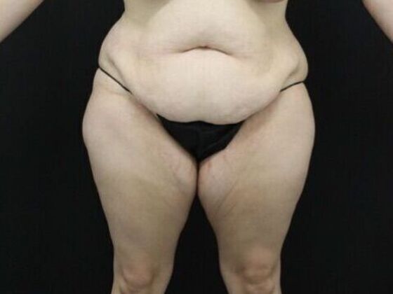 Tummy Tuck Case 44 - Before