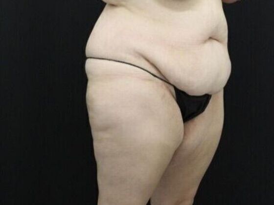 Tummy Tuck: Case 44 - Before