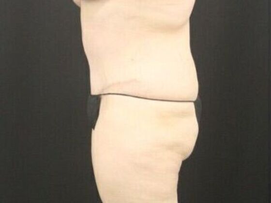 Tummy Tuck: Case 44 - After