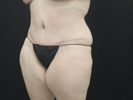 Tummy Tuck: Case 44 - Before