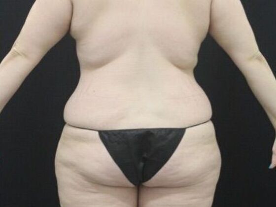 Tummy Tuck: Case 44 - After