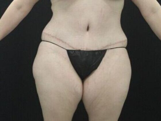 Tummy Tuck Case 44 - After