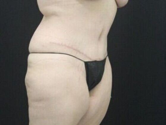 Tummy Tuck: Case 44 - After