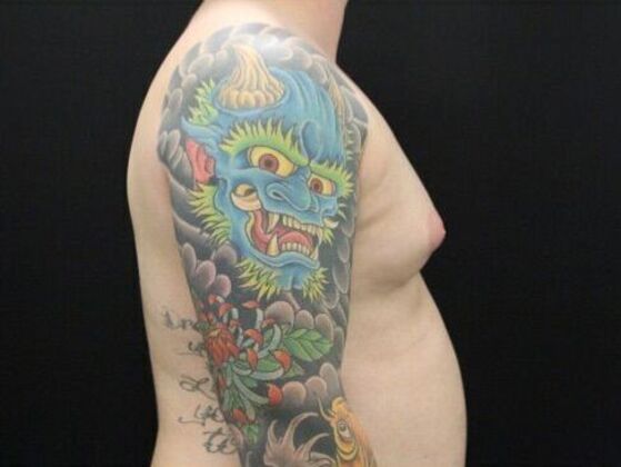 Gynecomastia: Case 8 - Before