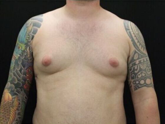 Gynecomastia Case 8 - Before