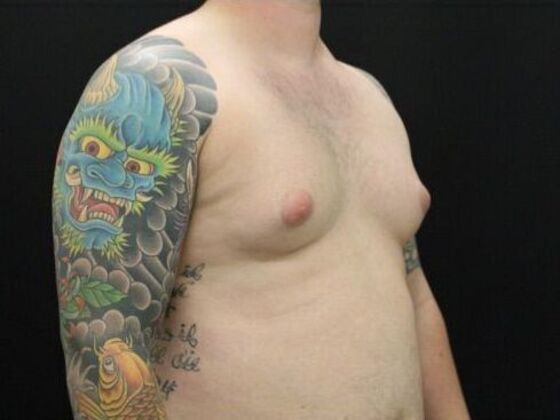 Gynecomastia: Case 8 - Before