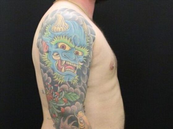 Gynecomastia: Case 8 - After