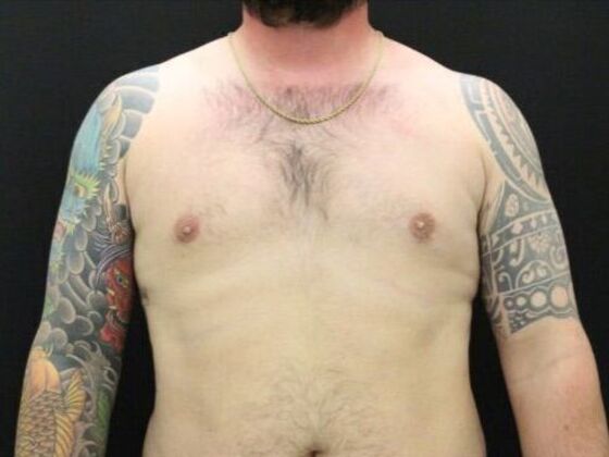 Gynecomastia Case 8 - After