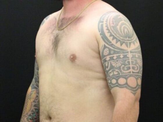 Gynecomastia: Case 8 - After