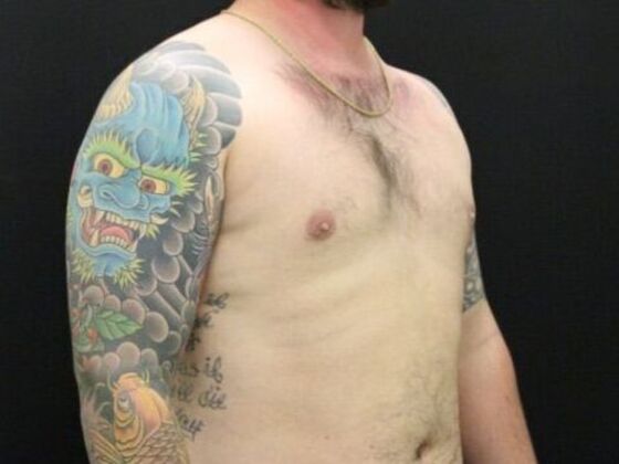 Gynecomastia: Case 8 - After