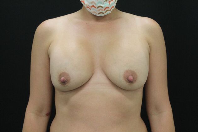 Breast Lift/Breast Lift Augmentation Case 36 - Before