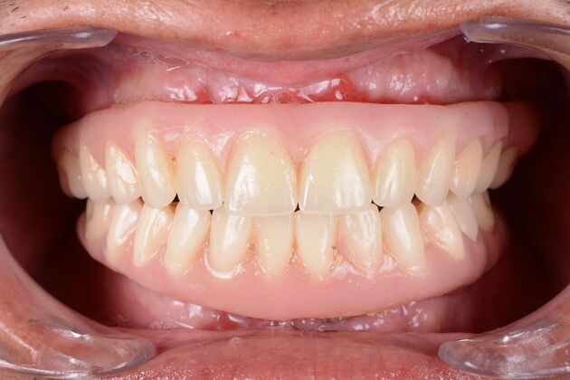 Our Results: ALL ON 6 UPPER AND LOWER TEETH IN A DAY - After