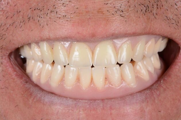 Our Results: ALL ON 6 UPPER AND LOWER TEETH IN A DAY - After