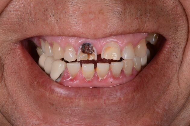 Our Results: ALL ON 6 UPPER AND LOWER TEETH IN A DAY - Before