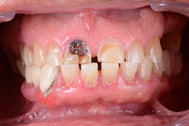 Our Results: ALL ON 6 UPPER AND LOWER TEETH IN A DAY - Before