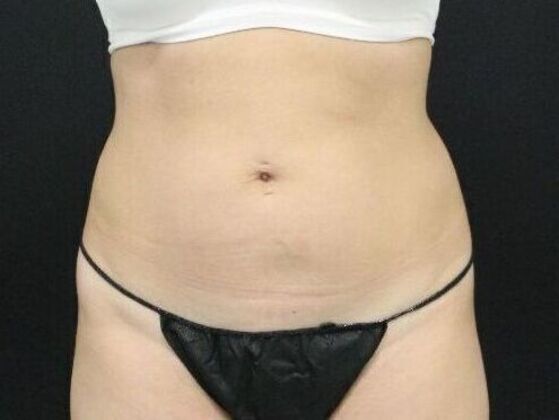 Liposuction Case 27 - Before