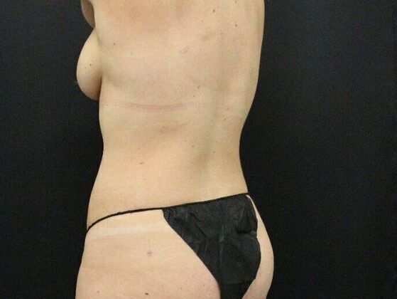 Tummy Tuck: Case 45 - Before