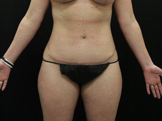 Tummy Tuck Case 45 - After