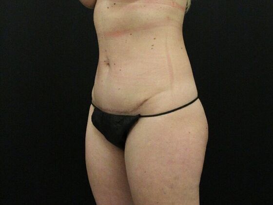 Tummy Tuck: Case 45 - After