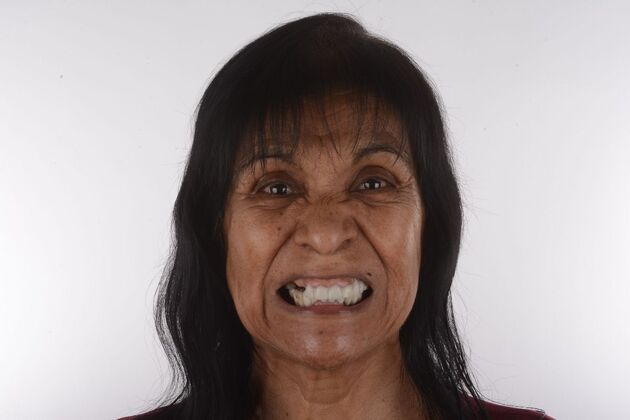 Our Results ALL ON  6 TEETH IN A DAY  - Before