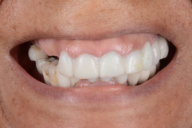 Our Results: ALL ON  6 TEETH IN A DAY - Before