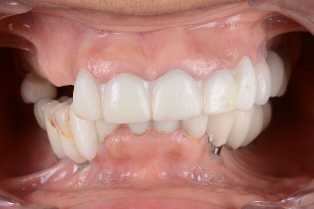 Our Results: ALL ON  6 TEETH IN A DAY - Before