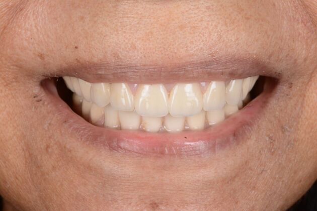 Our Results: ALL ON  6 TEETH IN A DAY - After