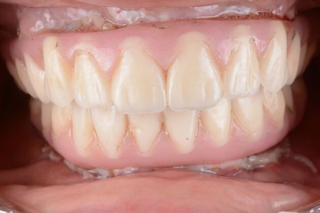 Our Results: ALL ON  6 TEETH IN A DAY - After