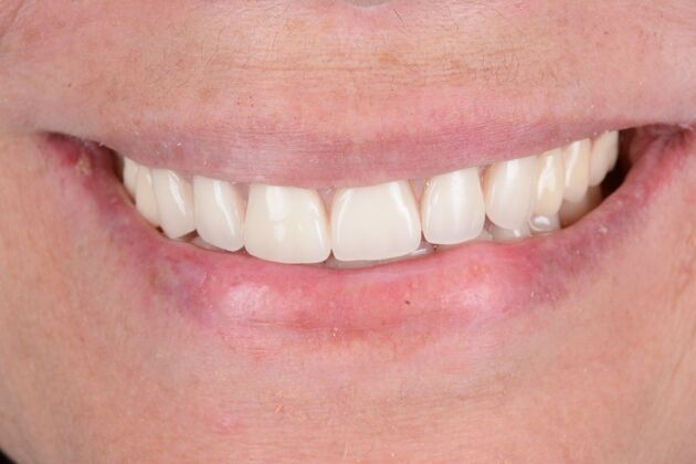 Our Results: UPPER AND LOWER ALL ON 6 TEETH IN A DAY - After