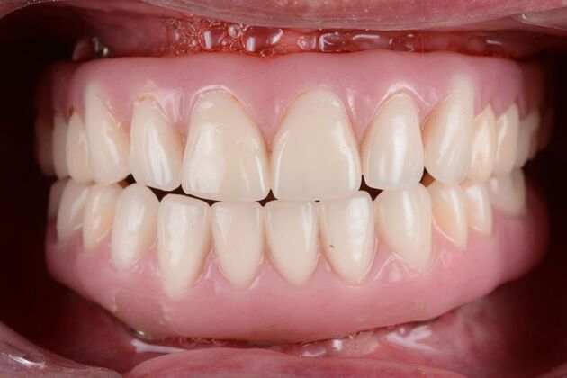 Our Results: UPPER AND LOWER ALL ON 6 TEETH IN A DAY - After