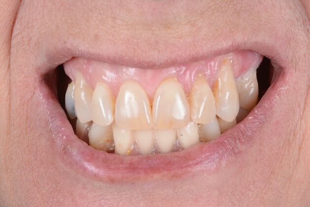 Our Results: UPPER AND LOWER ALL ON 6 TEETH IN A DAY - Before