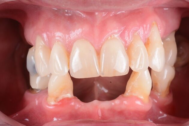 Our Results: UPPER AND LOWER ALL ON 6 TEETH IN A DAY - Before