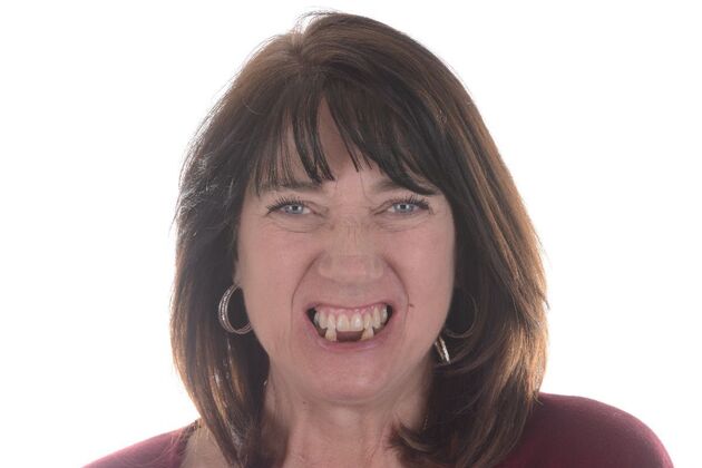 Our Results UPPER AND LOWER ALL ON 6 TEETH IN A DAY - Before